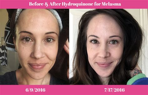 Before Hydroquinone System After ... All content in this document is for general information purposes only. The “Before and After” images are unretouched images ...